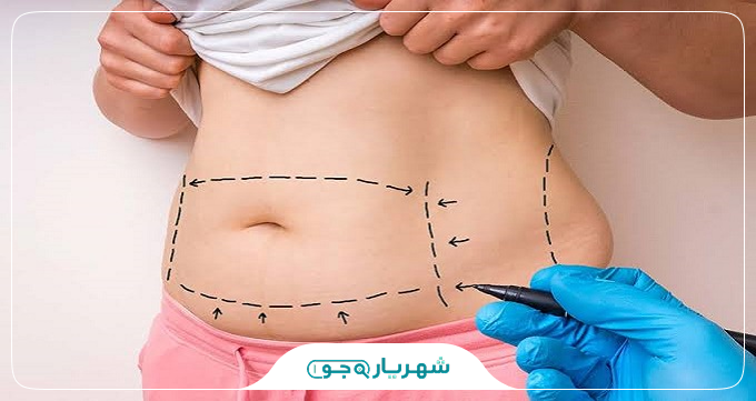 تفاوت ابدومینوپلاستی، لیپوساکشن و لیپوماتیک