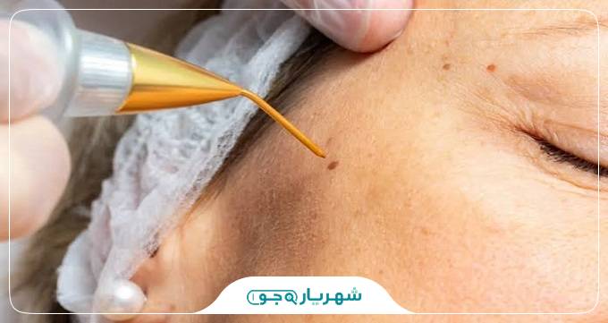 بهترین دکتر برداشت خال در ملارد